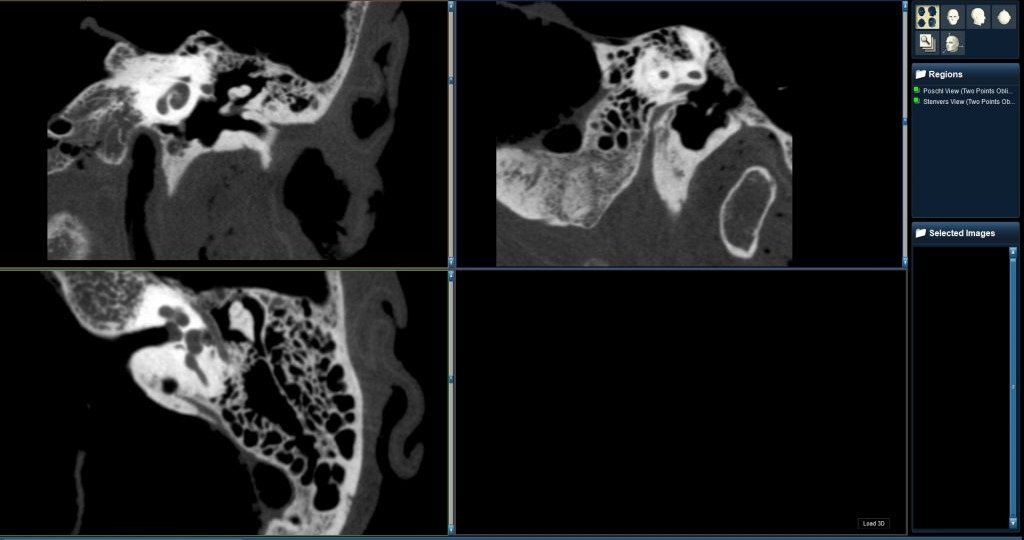 MiniCAT-Temporal-Bone-scan-at-70-microns-1024x575