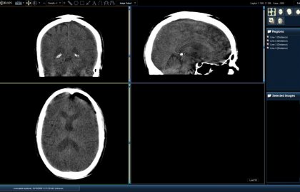 evacsubdural-mpr2-1024x640 evacsubdural-mpr2-1024x640
