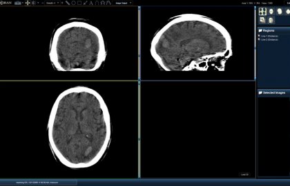resolving-ich-mpr-1024x640 resolving-ich-mpr-1024x640