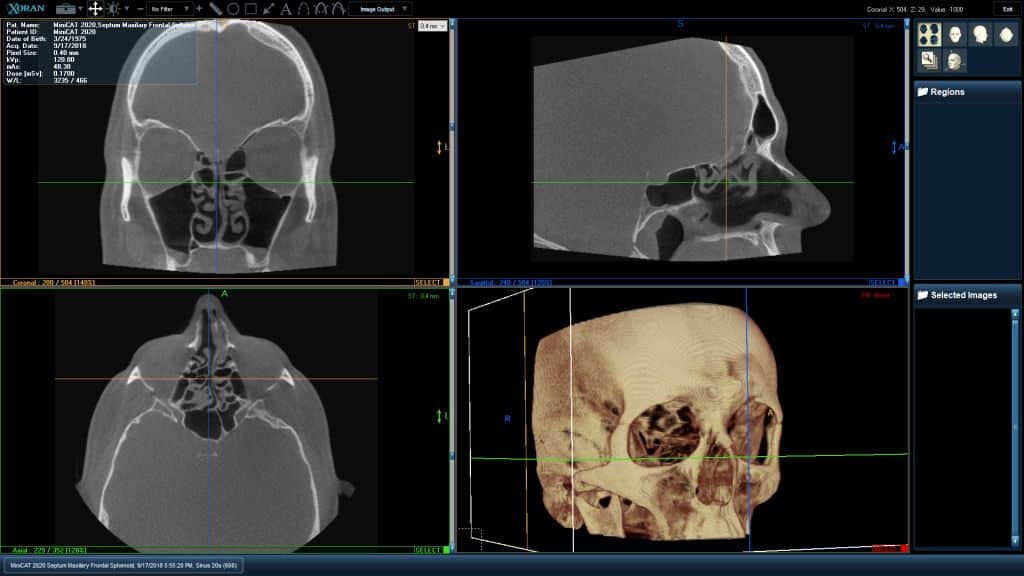 Sinus CT Scan Example