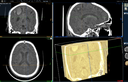 Multiple Lesions