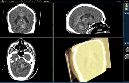 Posterior Fossa